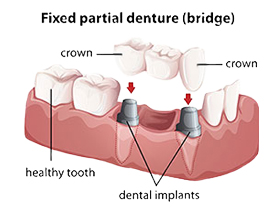 Porcelain Fixed Bridges | Holland Family Dental | Owatonna Dentist