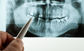 Panoramic X-rays | Holland Family Dental | Owatonna Dentist