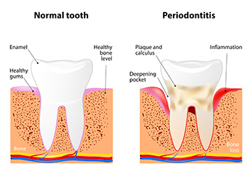  Periodontal Disease | Holland Family Dental | Owatonna Dentist