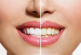 Tooth Whitening | Holland Family Dental | Owatonna Dentist