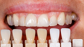 Porcelain Veneers | Holland Family Dental | Owatonna Dentist